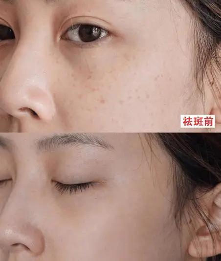 手背上特多老年斑用点什么药膏,老年斑凸起发痒擦什么药膏