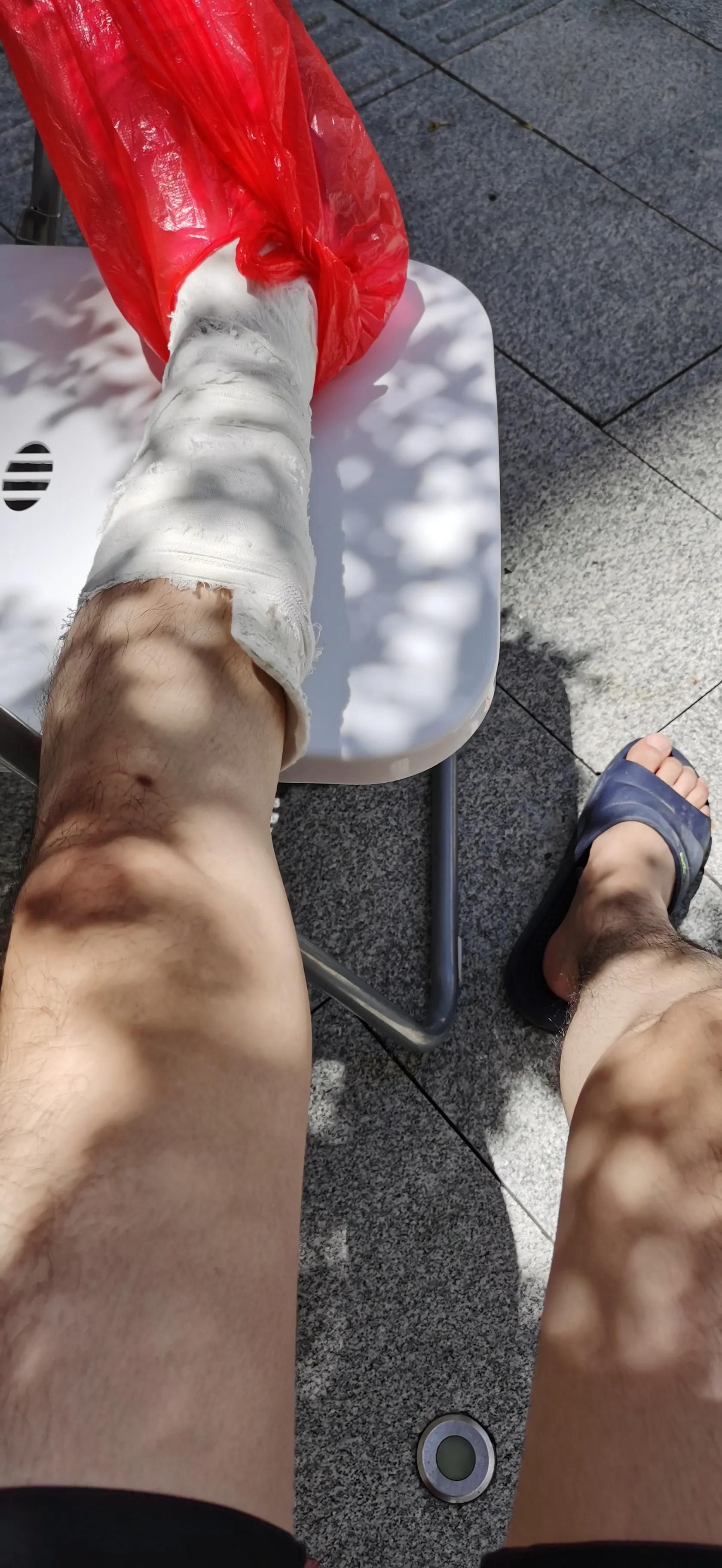 第五跖骨粉碎性骨折多久后能走路,第五跖骨基底骨折100天了走路肿