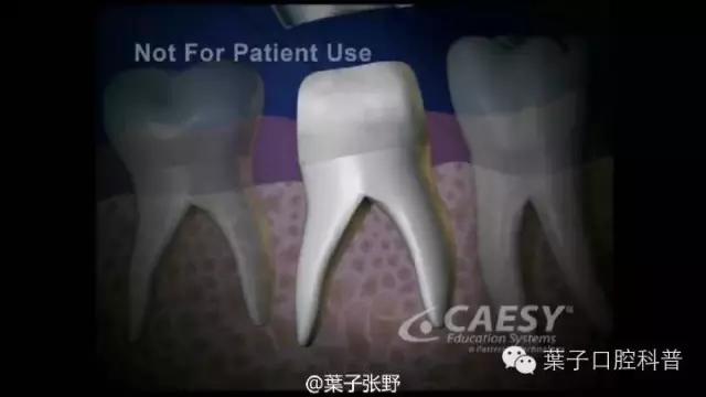 上牙龈上火突出一个鼓包,牙龈肿胀鼓包上火了吗