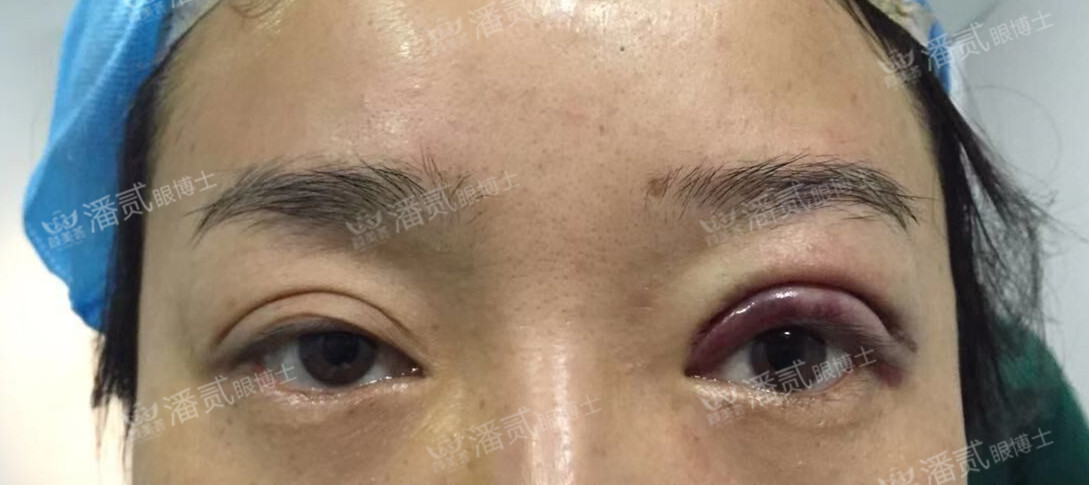 提肌矫正失败的表现眼皮睁不开,做完提肌眼睛前半段下垂