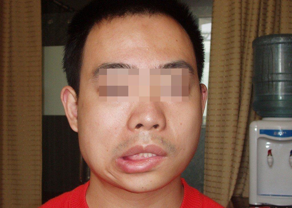 黏液表皮样癌是一种恶性肿瘤，侵犯面神经可引起腮腺的面神经麻痹