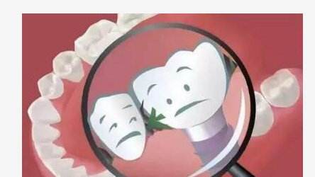 塞牙科普小视频,大牙塞牙修复方法