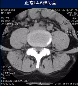 腰椎管狭窄的磁共振诊断标准,腰椎轻度退行性变化椎间盘膨出
