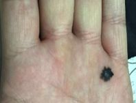 激光点痣不小心照了紫灯怎么办,切除黑色素痣可能癌变吗