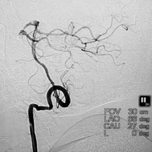 颅内巨大动脉瘤首选治疗技术,大脑中动脉动脉瘤闭塞的介入治疗