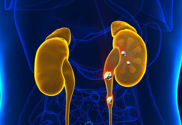 男子肾结石,男子无尿竟然是肾衰竭