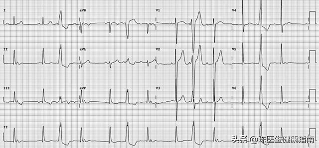 血压超过90140就确定高血压了吗,血压高于14090需要吃药吗