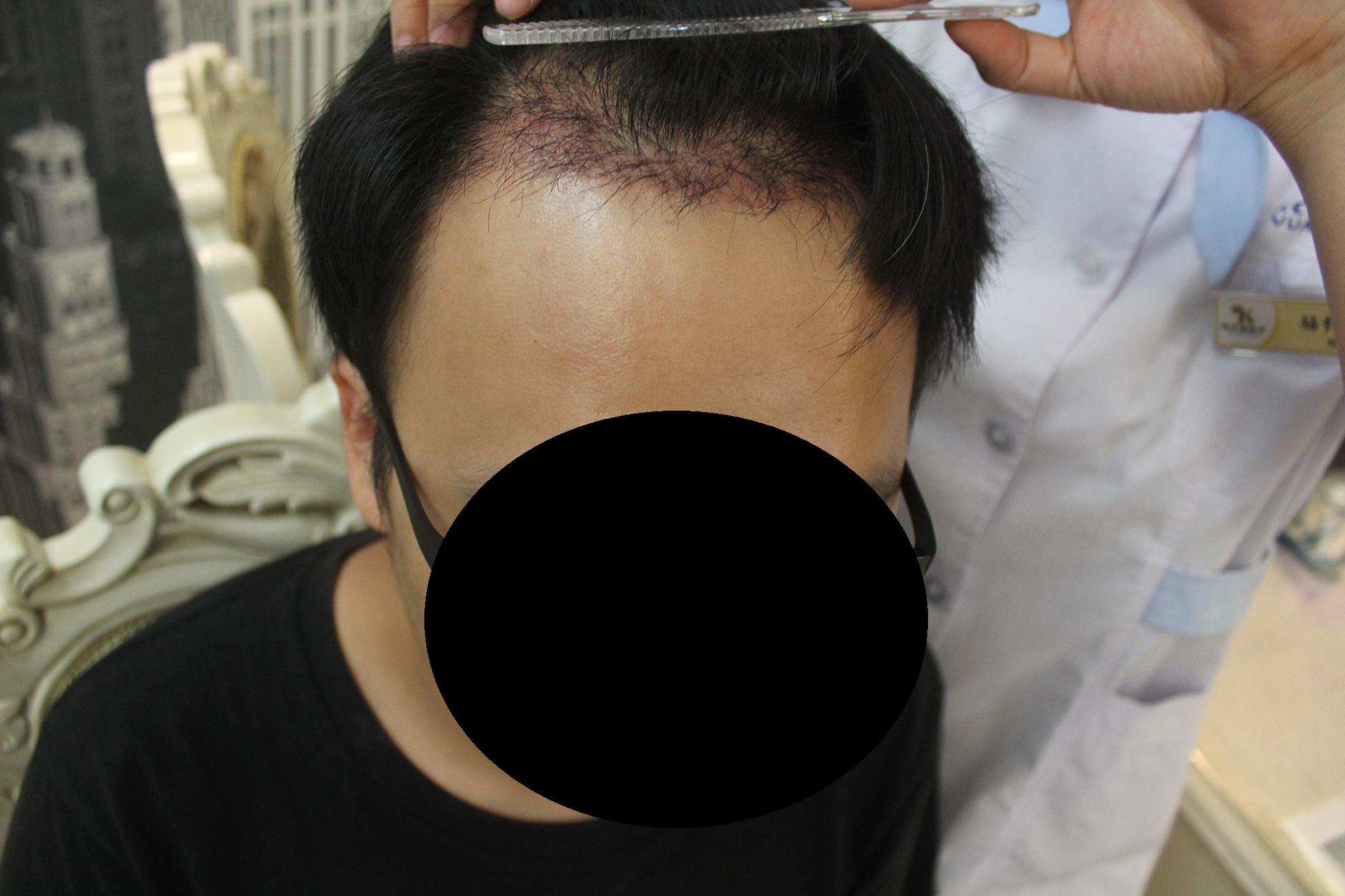 植发能和正常生长的头发一样长吗,植发靠谱吗