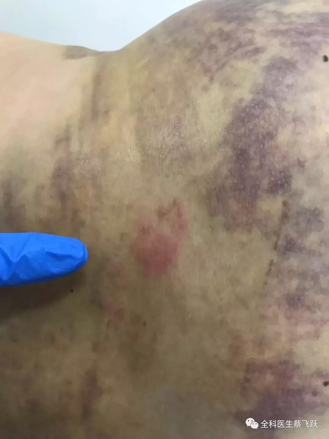 痛得像针扎火烧，她去看病，臀部反被“打”出一片淤伤…