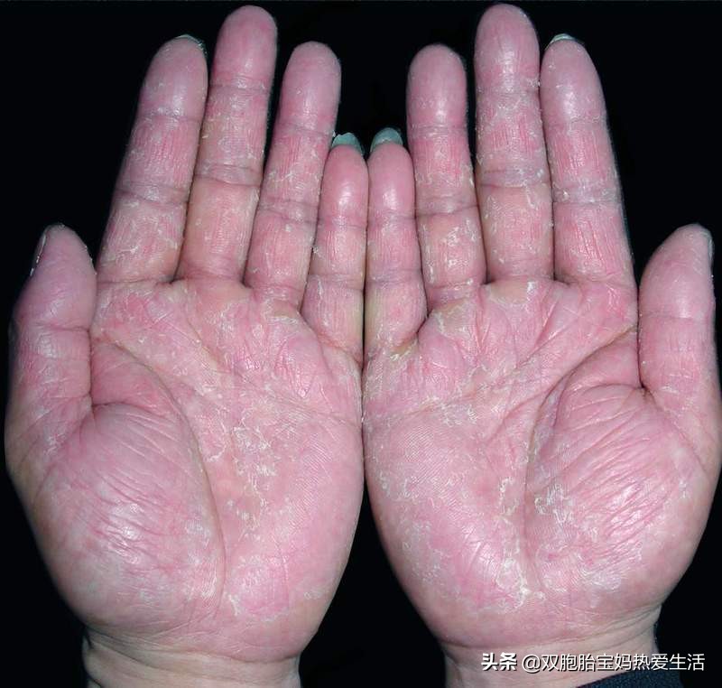 夏季到了，手上小水泡又起来了，奇痒脱皮，该如何预防和治疗