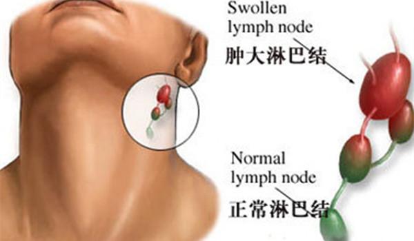 淋巴肿大怎么消除会引起发烧吗,淋巴结肿大可以做淋巴排毒吗