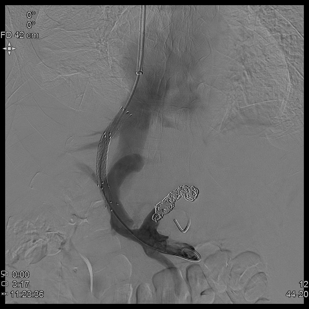 肝硬化引起门脉高压消化道出血,肝硬化消化道大出血怎么治疗