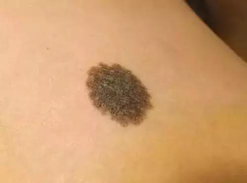 小孩子有痣怎么判断是否癌变,小孩脸上长痣会不会恶变