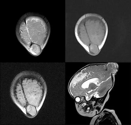 先天性颅脑发育不全,先天颅脑发育不良能治吗