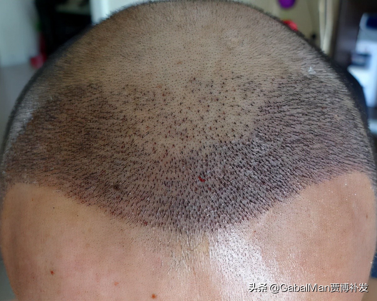 发际线极为危险,发际线有什么讲究