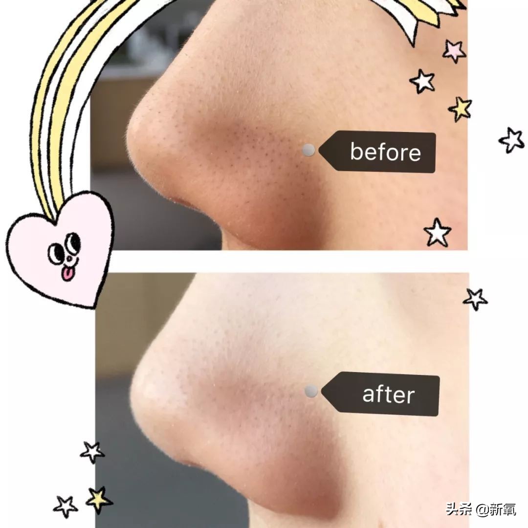 目前有真正去黑头的方法,最近超火的去黑头