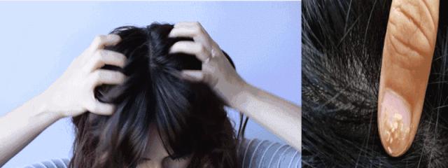 头皮屑严重如何处理好得快,头皮屑是怎么造成的如何治好