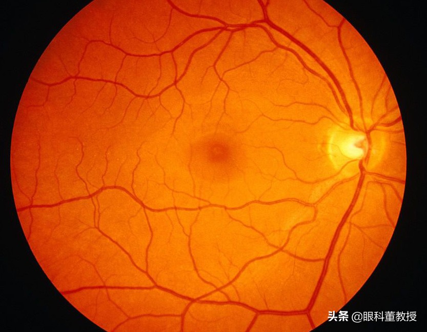 老人单侧眼睛突然视力下降,老人单眼视力下降眼底病变