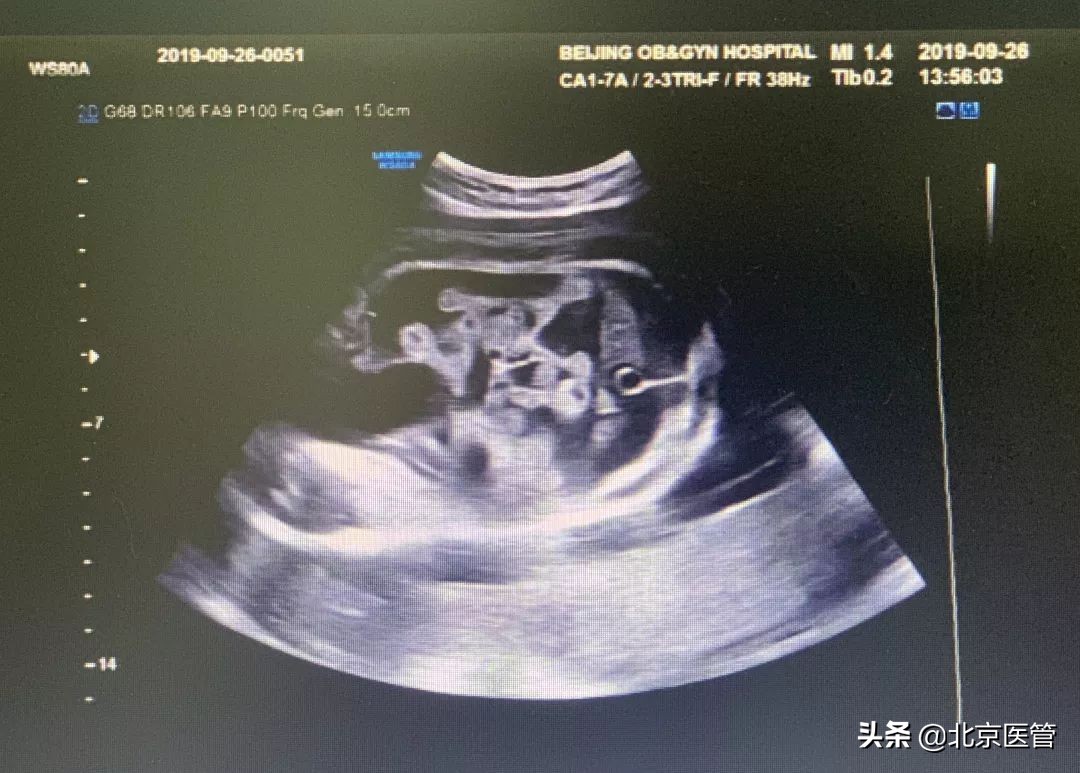 怀孕8周胎心停了怎么抢救,怀胎八月胎动