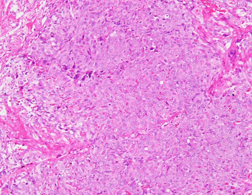 弥漫性肺泡出血能治好吗,弥漫性肺泡出血能活多久