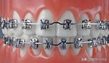 牙医的良心忠告牙齿矫正,别急着牙齿矫正先弄懂这10件事