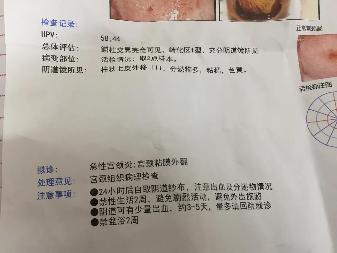 hpv58治疗期间注意事项,hpv58一级病变转阴历程