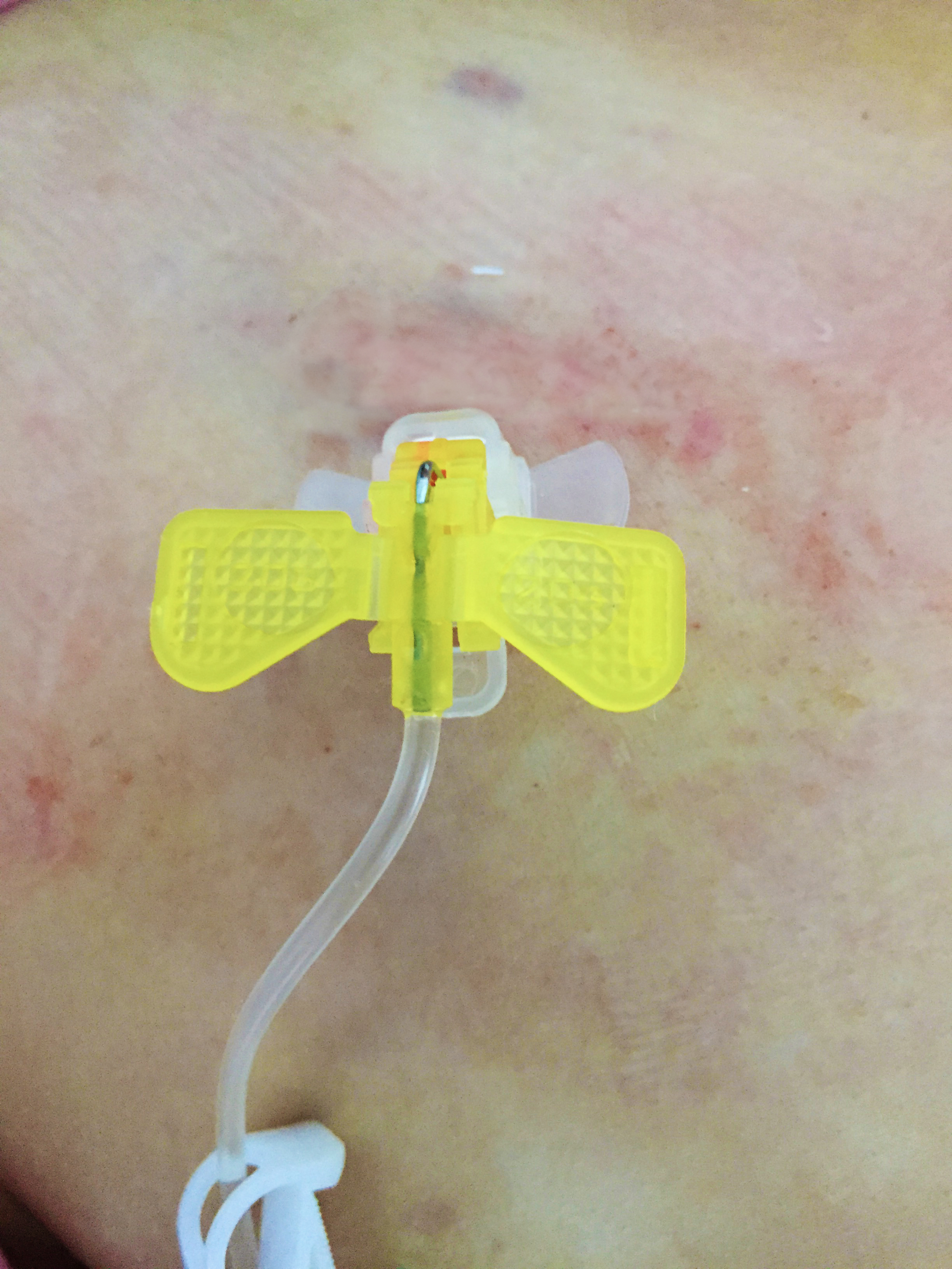 医院首例下腔静脉滤器植入,静脉输液港植入后效果图