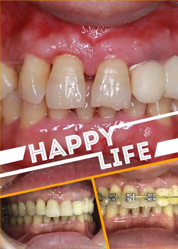 40岁戴牙套可以矫正牙齿吗,40岁牙齿外凸可以矫正吗