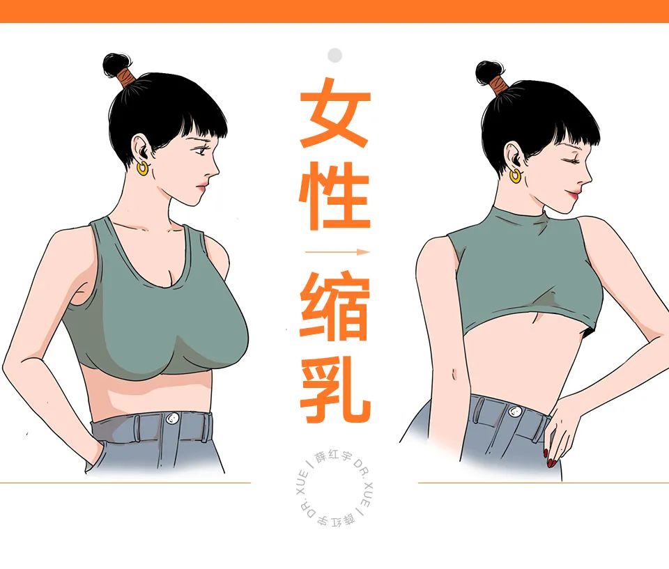 乳房缩小常见术式,乳房缩小术解除乳房过大的烦恼