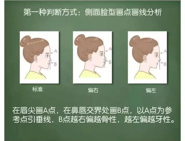 突嘴正颌手术有哪些风险,正颌手术凸嘴3d动画演示