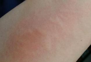 涂花露水有什么危害,涂花露水引发大抢救