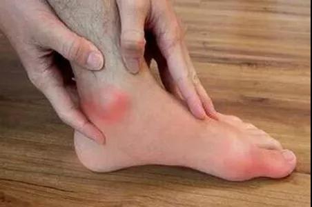 吃了痛风药多久可以备孕男士,痛风患者备孕怎么办