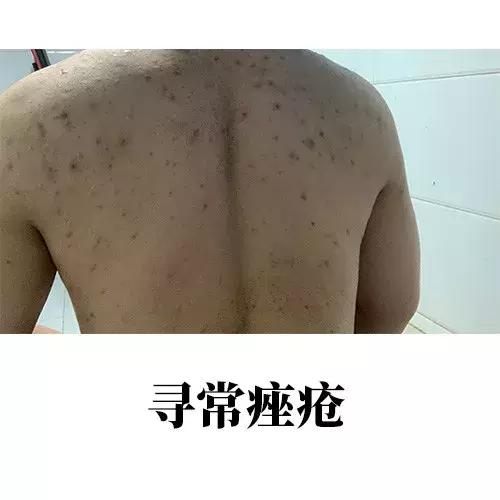 背上的青春痘,16岁背上长青春痘