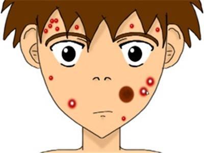 脸上长痘反反复复如何有效祛痘,脸上反复长痘怎么根除中医