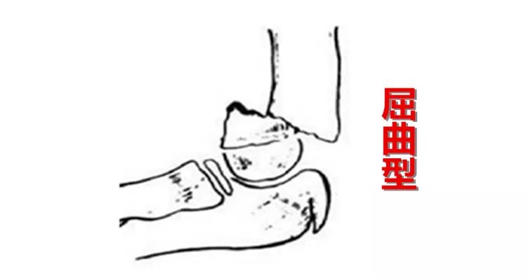 小孩胳膊骨折的治疗方法,胳膊骨折后骨折处发热怎么回事