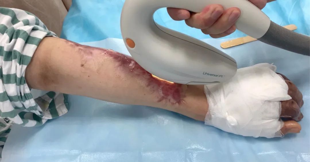 疤痕疙瘩怎么治疗最好最快,疤痕疙瘩中药治疗成功案例