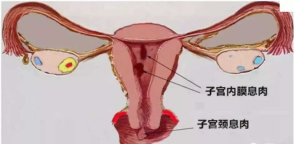 肠息肉胃息肉,肠息肉和胆囊息肉必须做手术吗