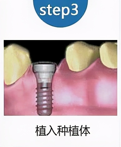老人家种牙去哪里最好,50岁种牙最好方法怎么种