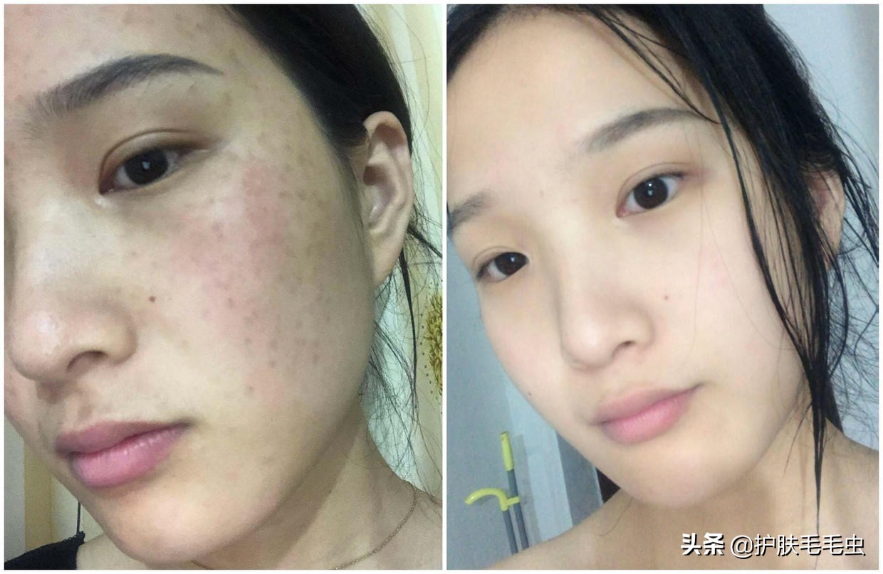 脸颊两边长斑最有效的淡化妙招,脸颊两侧长斑几年了怎么去除