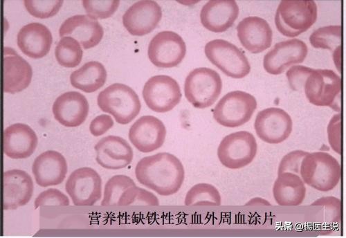 儿童贫血看血常规哪个指标,缺铁性贫血血常规看哪几项