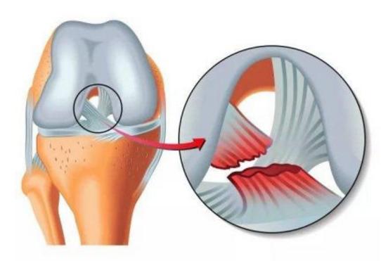 跑步爬楼梯腿会变粗嘛,爬山跑步会磨没软骨吗