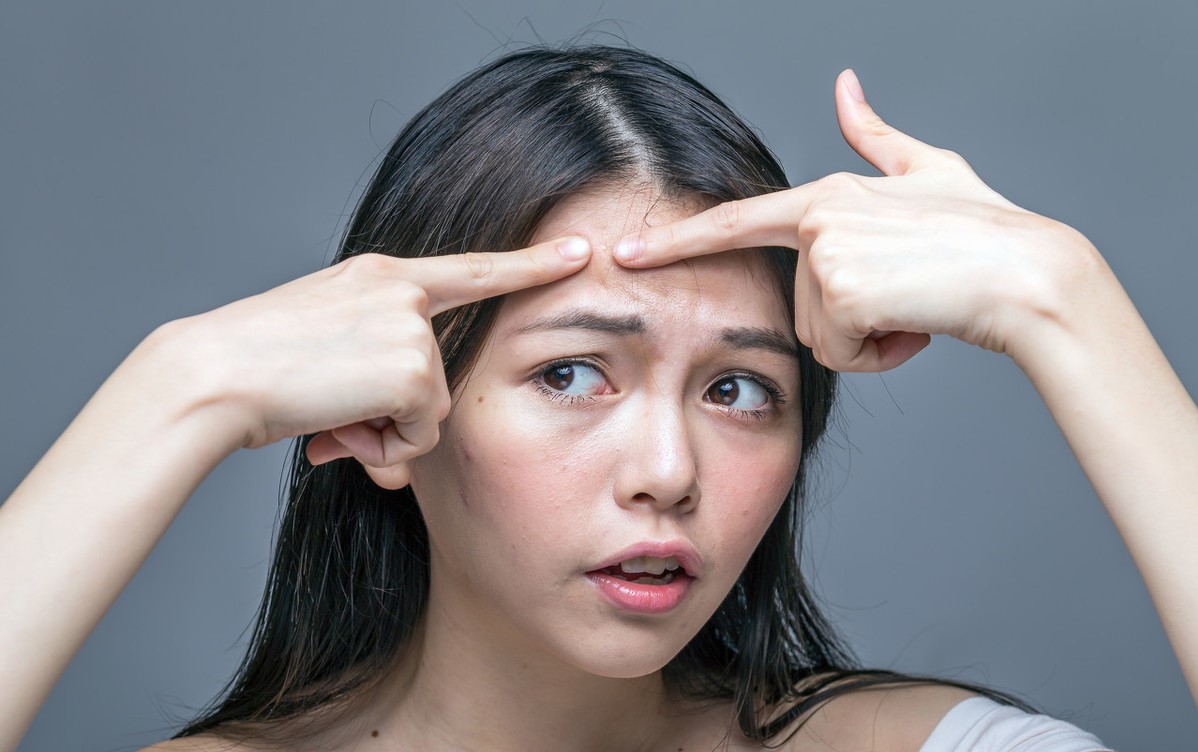 治疗痤疮的常用药维胺酯,治疗痤疮的维a酸类的药物