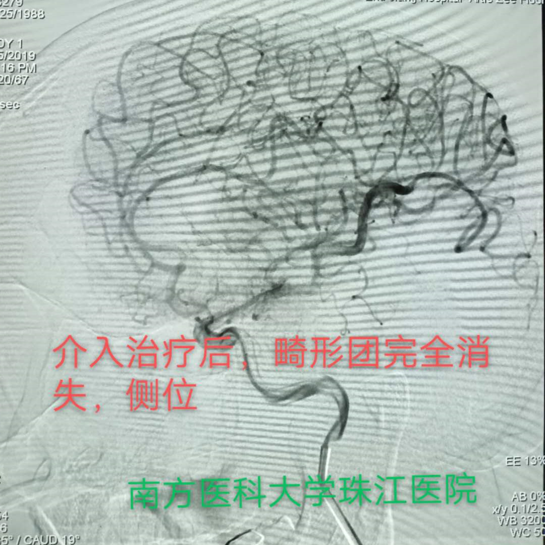 脑动静脉畸形可选用的栓塞物,脑动静脉畸形做伽玛刀后康复