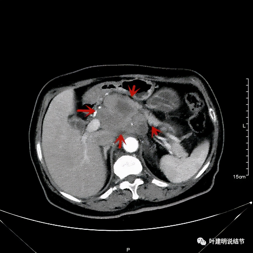 特瑞普利单抗食管癌成功案例,特瑞普利单抗治疗食管癌效果好吗