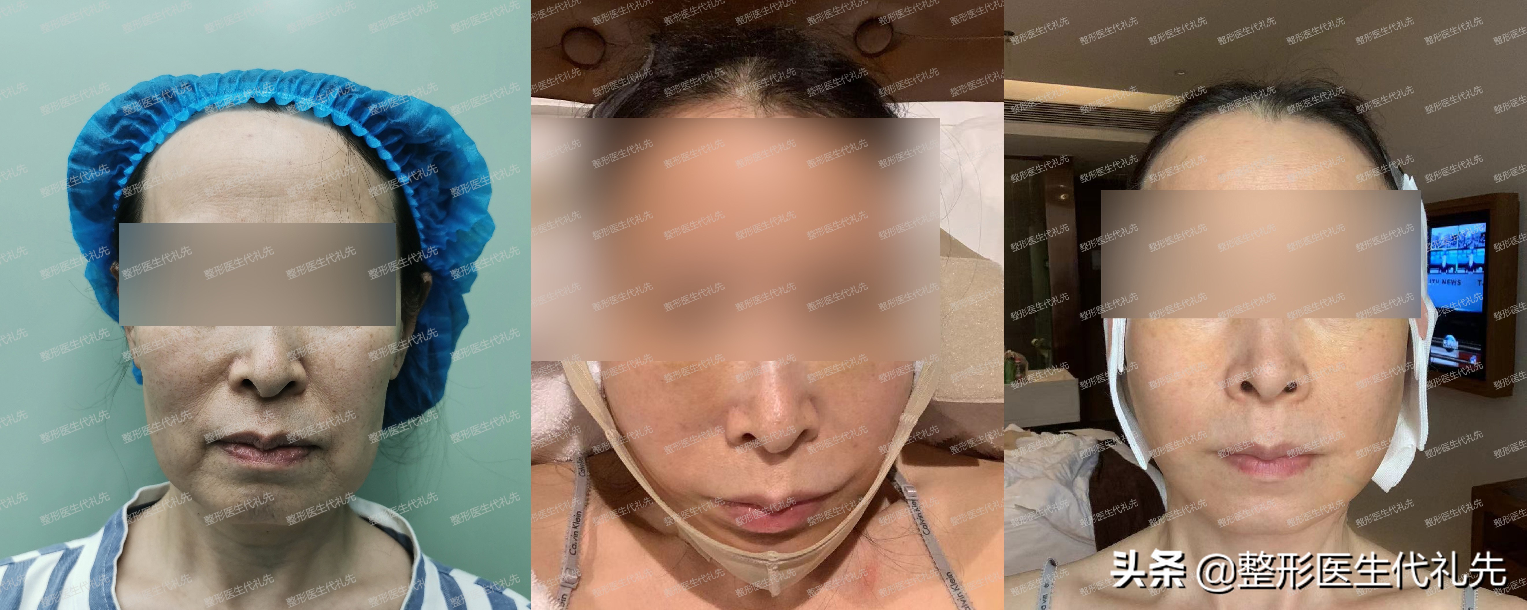 拉皮贴神器去法令纹有用吗,拉皮手术可以去除法令纹