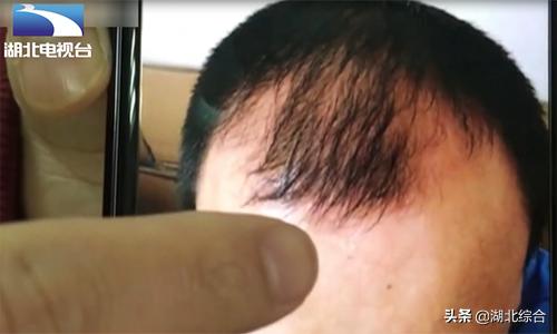 男子生发疗程没效果,男子生发秘方