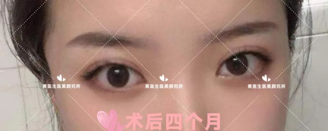 微创双眼皮10毫米,微创双眼皮切口一般多久愈合