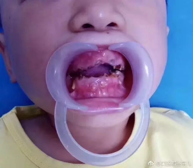 六岁小朋友满嘴黑牙怎么办,儿童满口烂牙视频