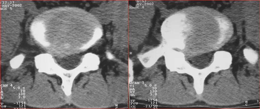 颈椎腰椎疾病ct及mri诊断,腰椎ct可以发现肠部病变吗