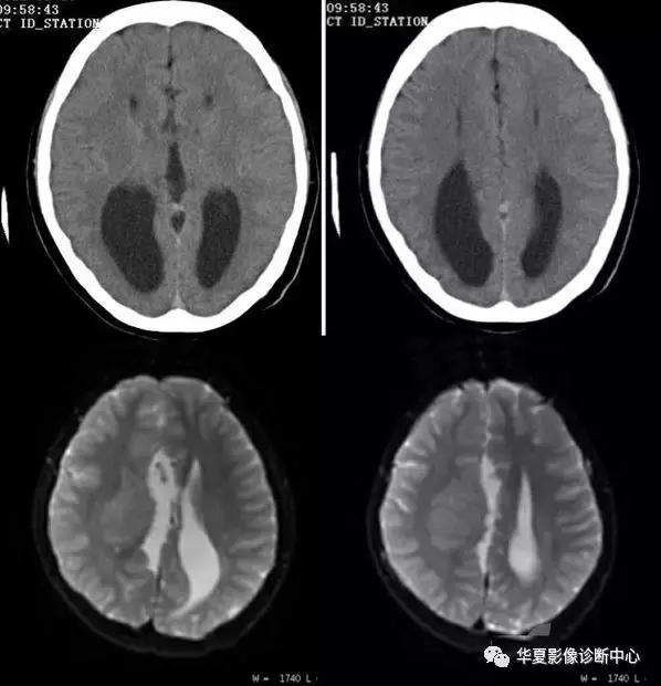 颅脑核磁影像解剖图谱,颅脑mr增强影像图片